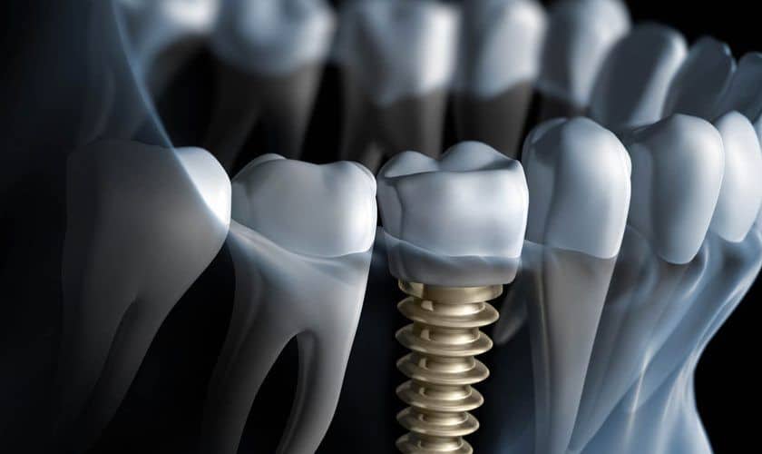 Featured image for “Implant Renaissance: A New Age of Smiles with Dental Implants”