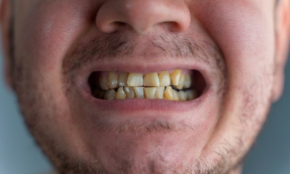 Featured image for “How Do You Get Cigarette Tar Off Your Teeth?”