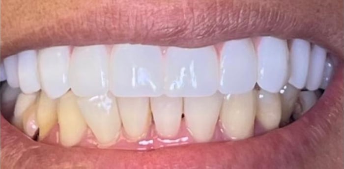 Implant Prosthesis Before