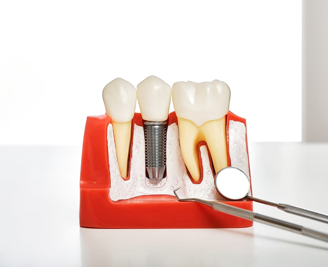 Featured image for “Dental Implants in Elgin, IL | Northeast Family Dental Care”