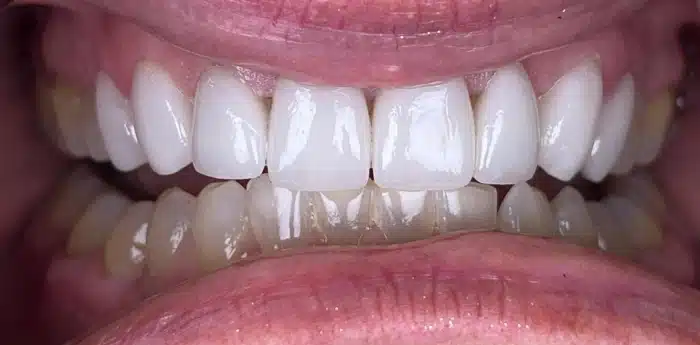 Cosmetic dentistry smile – after treatment