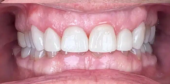 Dental smile transformation – after treatment