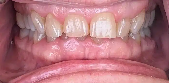 Dental smile transformation – before treatment