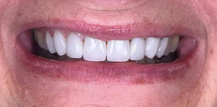 Smile makeover results – after treatment
