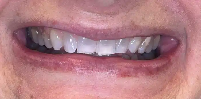 Smile makeover results – before treatment