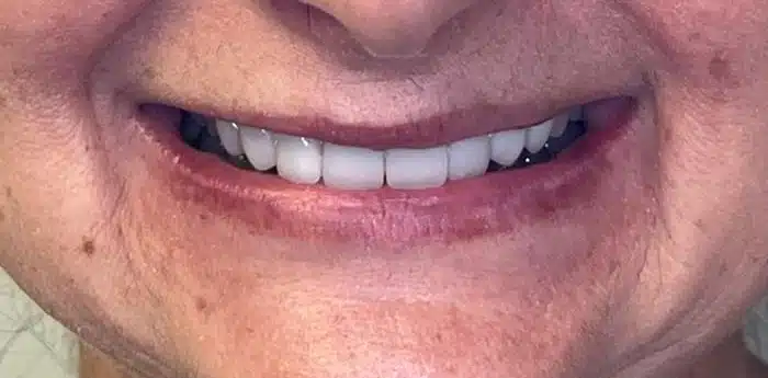 Smile restoration – after treatment