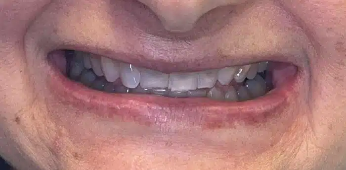 Smile restoration – before treatment