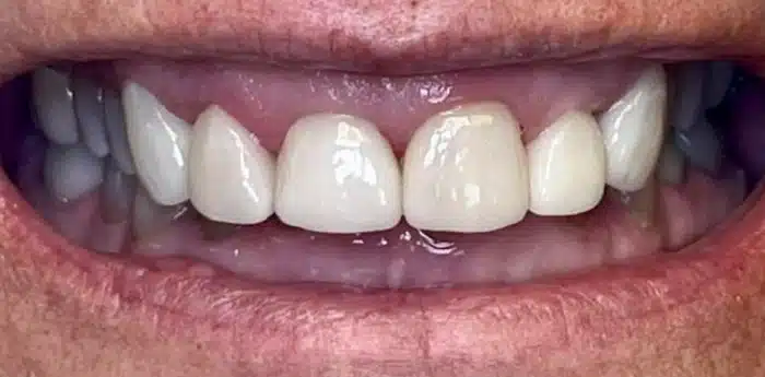 Teeth restoration results – after treatment