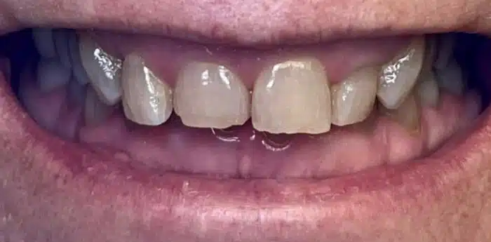 Teeth restoration results – before treatment