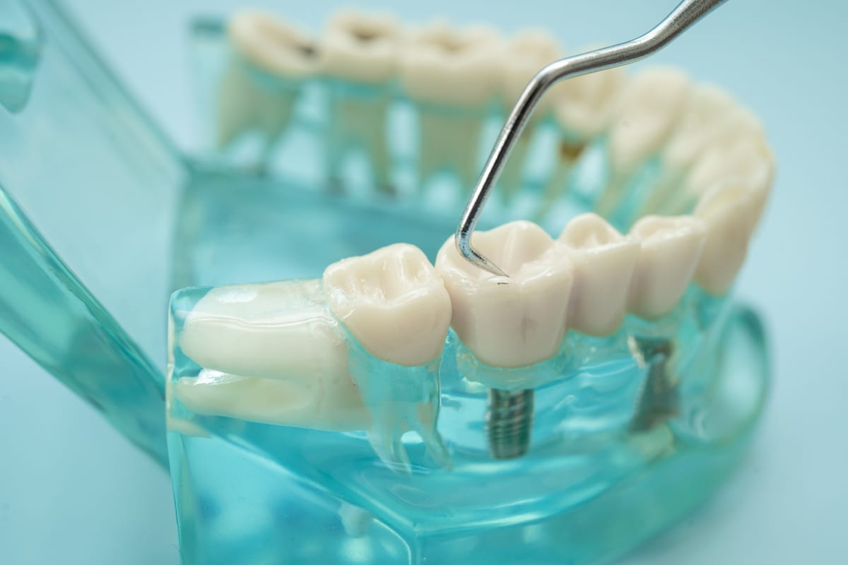 Featured image for “What Actually Happens During Your Full-Mouth Restoration Appointment”